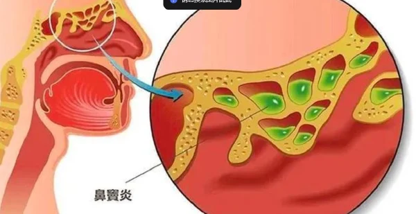 老年患者鼻内镜手术麻醉:如何平衡风险与安全?