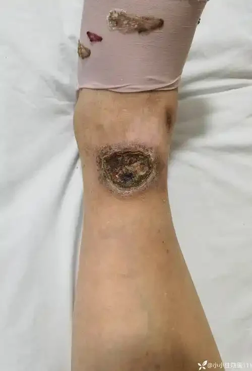 认识皮肤溃疡及其预防措施