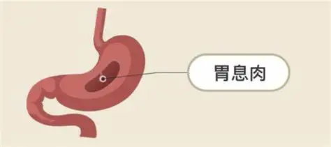 慢性胃炎与胃息肉:肠胃健康的隐形杀手