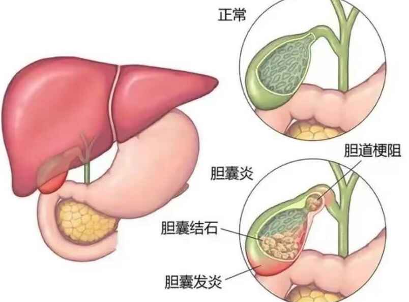 科普，胆囊结石伴慢性胆囊炎：从诊断到治疗的全面解析封面图
