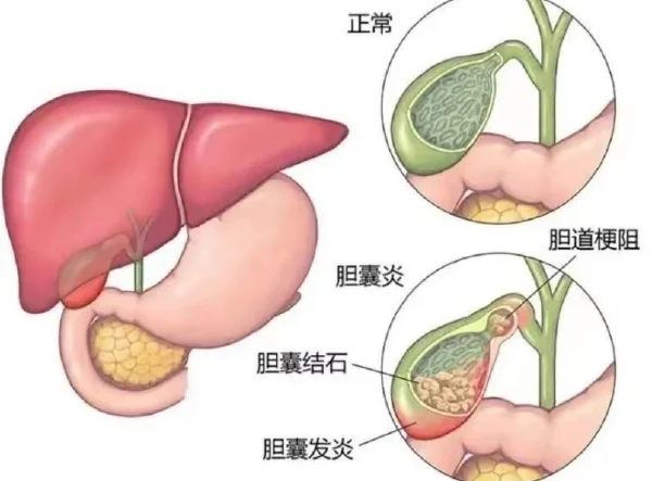 胆囊结石伴慢性胆囊炎:从诊断到治疗的全面解析