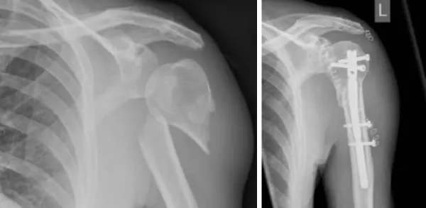 肱骨近端骨折科普手册：了解、治疗与预防