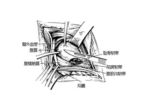 揭开腹股沟疝的“秘密”: 健康从预防开始