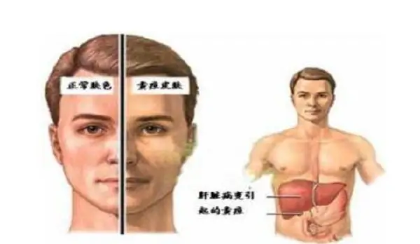上腹部不适伴黄疸?—了解十二指肠占位性病变