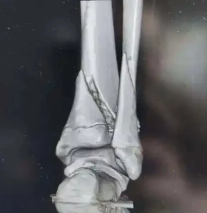 胫骨远端骨折的综合管理:从诊断到康复