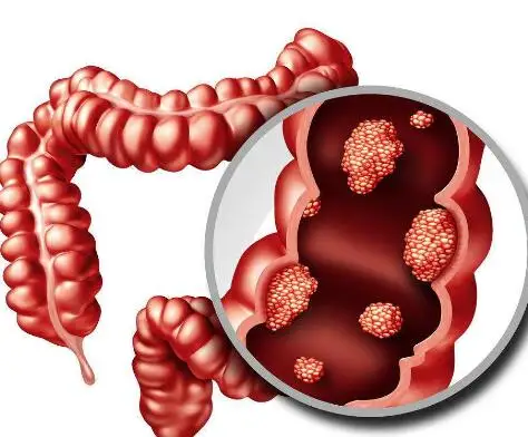 老年人直肠癌：如何积极面对并预防这类潜在致命疾病
