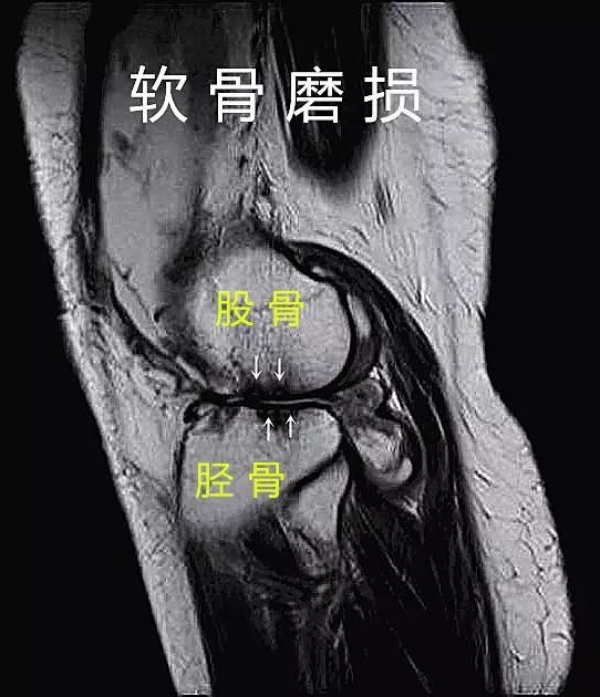 踝关节软骨损伤：隐性问题，重视关节健康