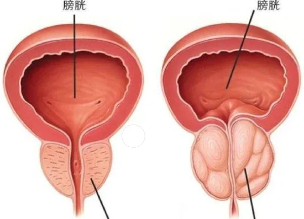 前列腺增生：全面了解与科学管理