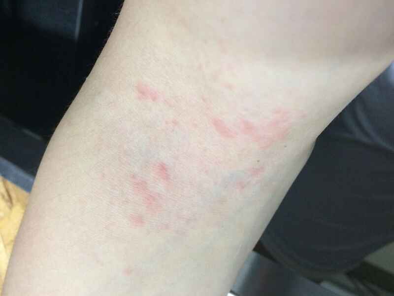 当心湿疹！你可能不知道的过敏真相封面图
