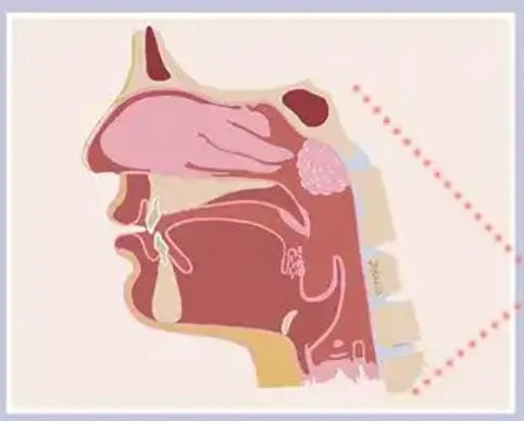 全面解析急性上呼吸道感染：类型、诊断、治疗及患者管理