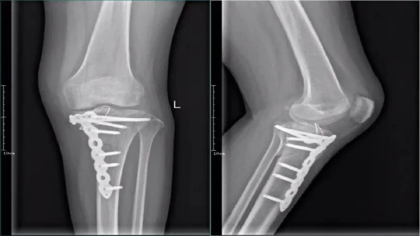 麻醉在骨折手术中的关键作用与风险控制
