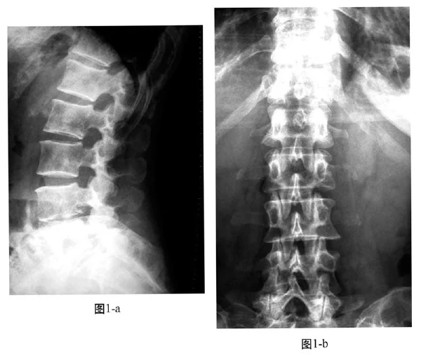 脊柱肿瘤手术中的麻醉管理：如何确保安全与效果？