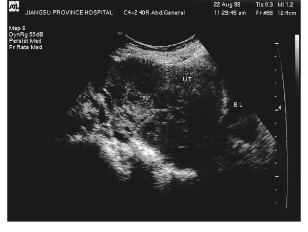 子宫肌瘤知多少?——女性健康的隐形“敌人”