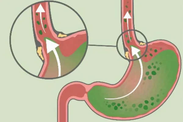 全面解析反流性食管炎:从诊断到治疗