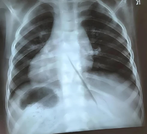 摆脱急性支气管炎的困扰：对症治疗和有效预防