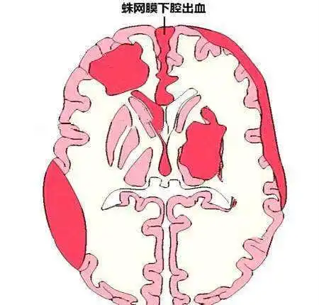 脑膜瘤与蛛网膜下腔出血:危险信号不容忽视!