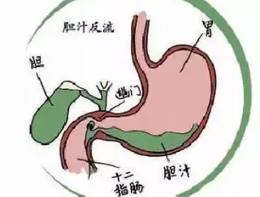 胆汁反流性胃炎及胃肠感冒的诊断与治疗