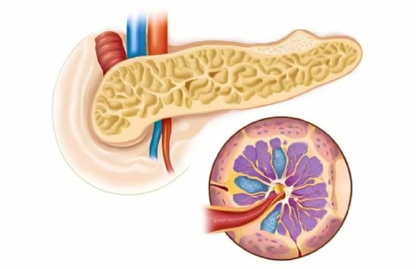 全面解读急性胰腺炎：从分类到管理