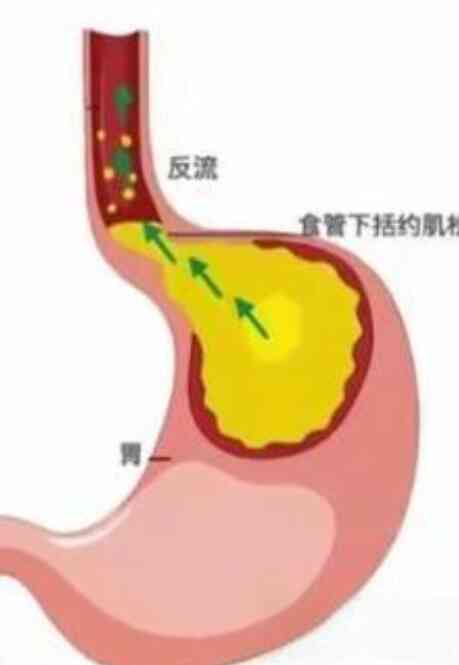 胃食管反流病的诊断与治疗：从基础到前沿封面图