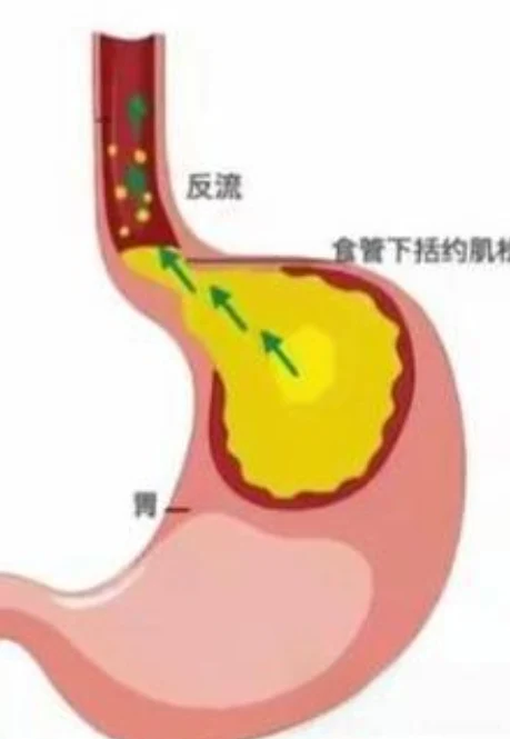 胃食管反流病的诊断与治疗:从基础到前沿