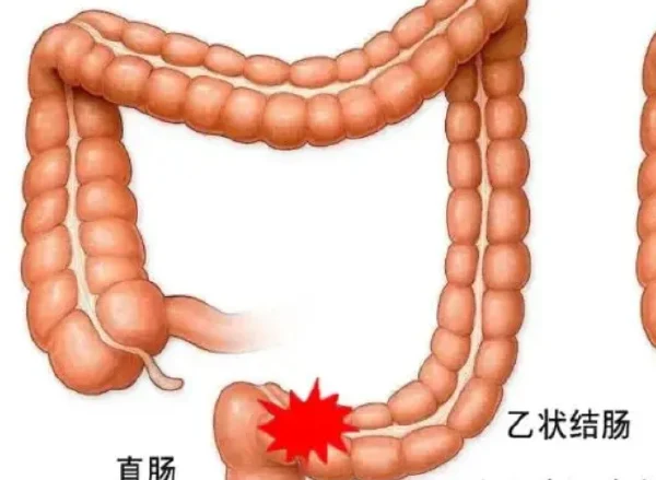 乙状结肠恶性肿瘤:全面了解及科学管理