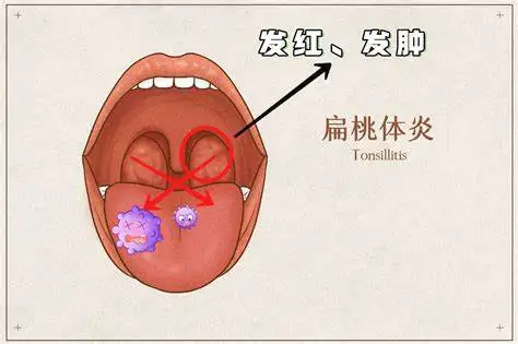 全面解读急性扁桃体炎:诊断、治疗与管理