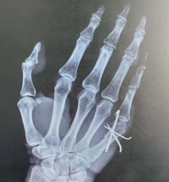 掌骨骨折？了解一下！——预防和治疗都在这里！