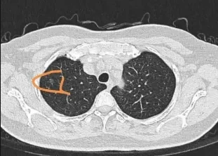 震惊！医生从CT中发现了这种常见的潜在危害——你了解肺部微结节吗？
