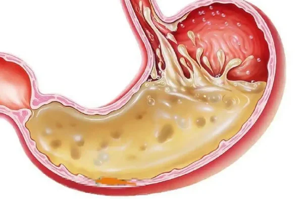 深入探讨消化性溃疡的分类、诊断与管理
