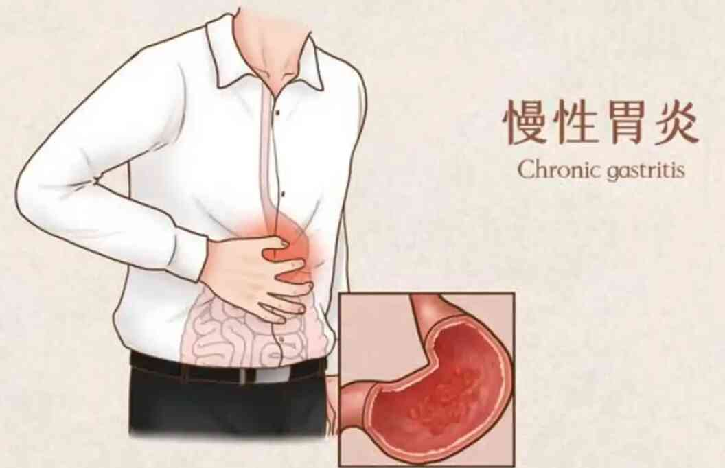 慢性胃炎及<span style="color: #da4707">内痔</span>：诊断与治疗的全面指南