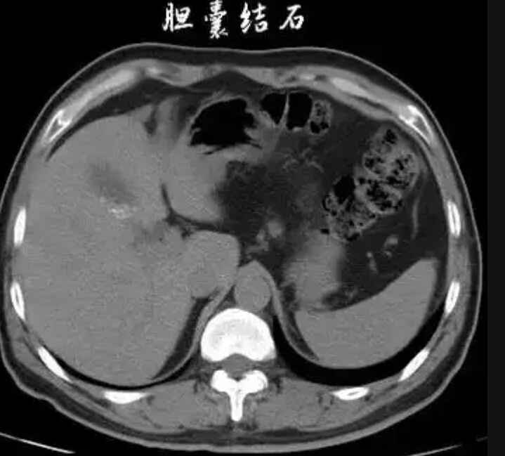 科普，探秘胆囊结石及其治疗：<span style="color: #da4707">专业</span>详解