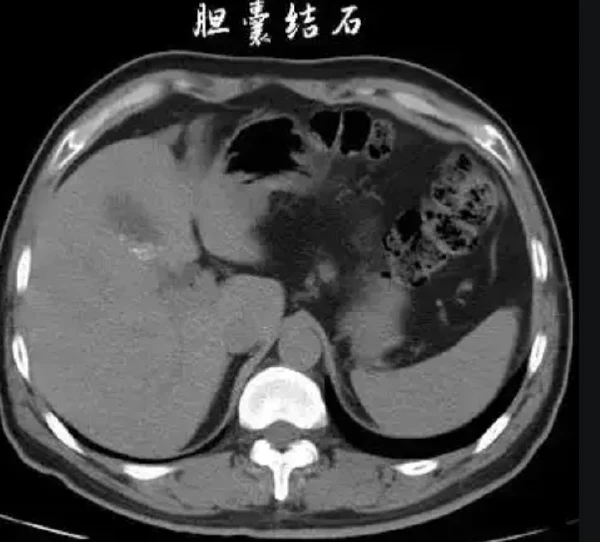 高龄患者腹腔镜胆囊切除术的麻醉管理:如何平衡风险与安全?