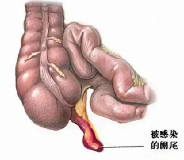 阑尾炎不容忽视！教你如何早期发现和有效治疗