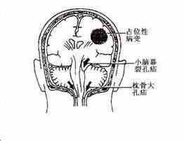 颅内占位性病变的全面解析