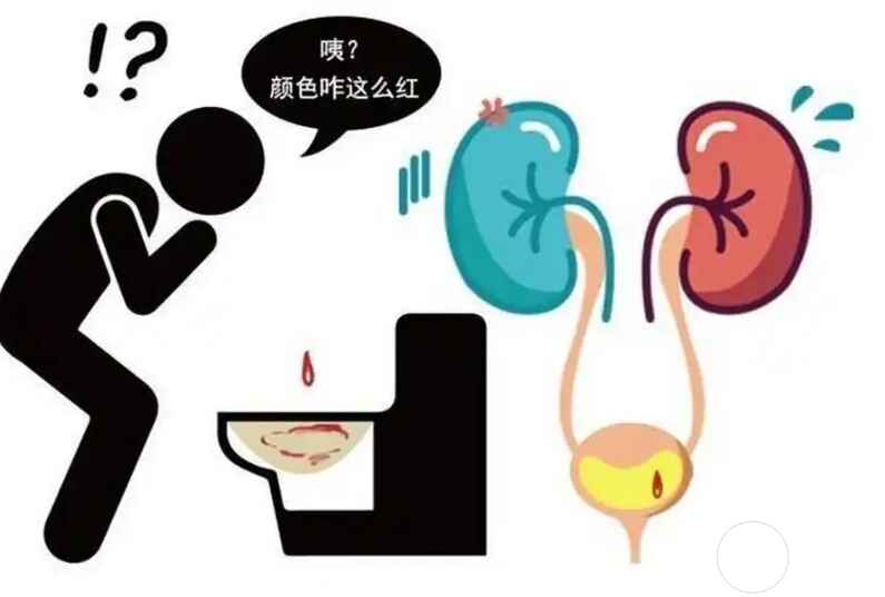 科普，<span style="color: #da4707">血尿</span>：你需要知道的一切以及预防措施