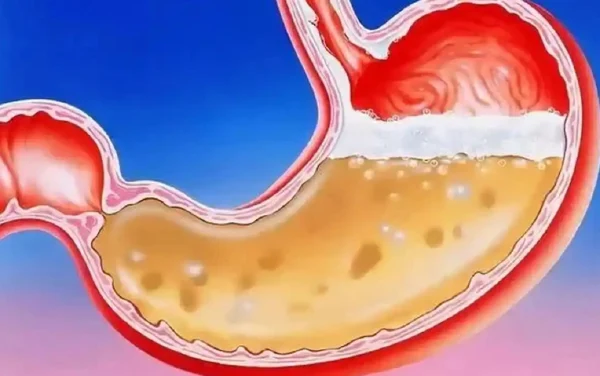 胃食管反流病——不可忽视的健康隐患!