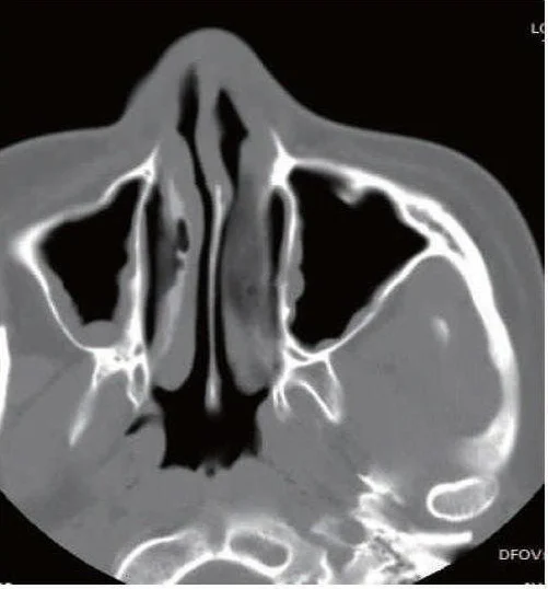 慢性鼻窦炎:全面解读诊断与治疗