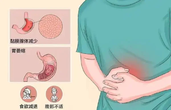 慢性萎缩性胃炎：关注胃部健康，防患未然