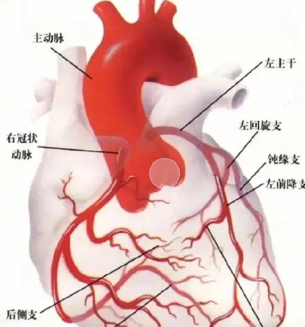 冠状动脉粥样硬化性心脏病的全面概述