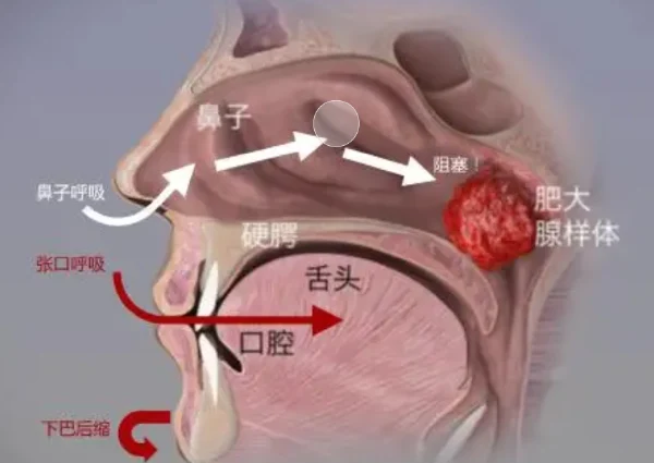 腺样体肥大的隐患!别让它困扰你的生活