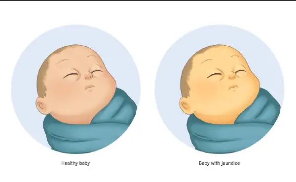 深度了解:梗阻性黄疸及其预防方法