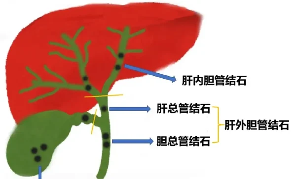 探索肝胆管结石的临床诊断与治疗