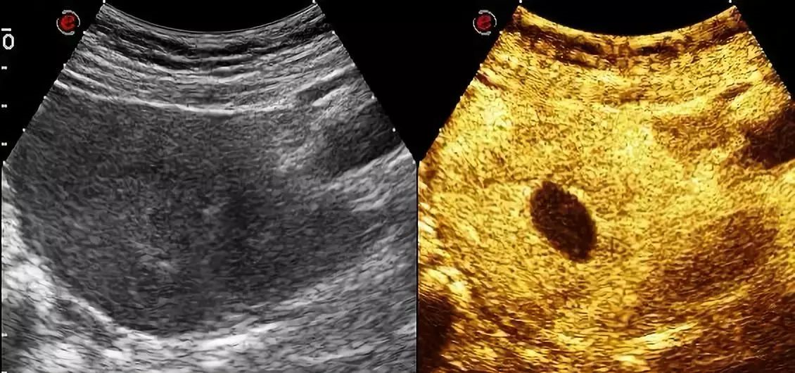 子宫腺肌症的系统解析：分类、诊断及前沿治疗手段