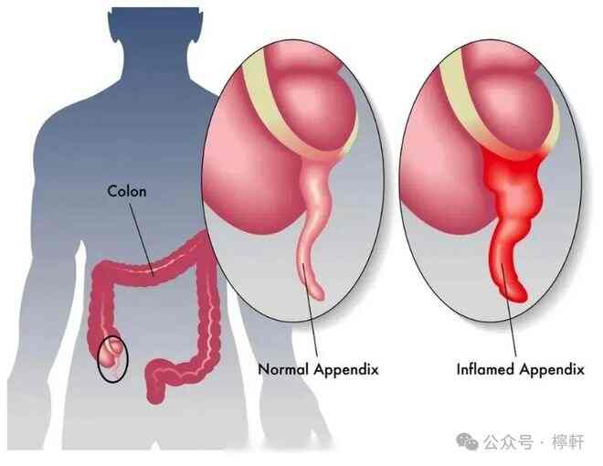 急性阑尾炎突发！这些症状你必须知道！