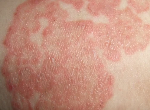 了解过敏性皮炎:从诊断到治疗全流程解析