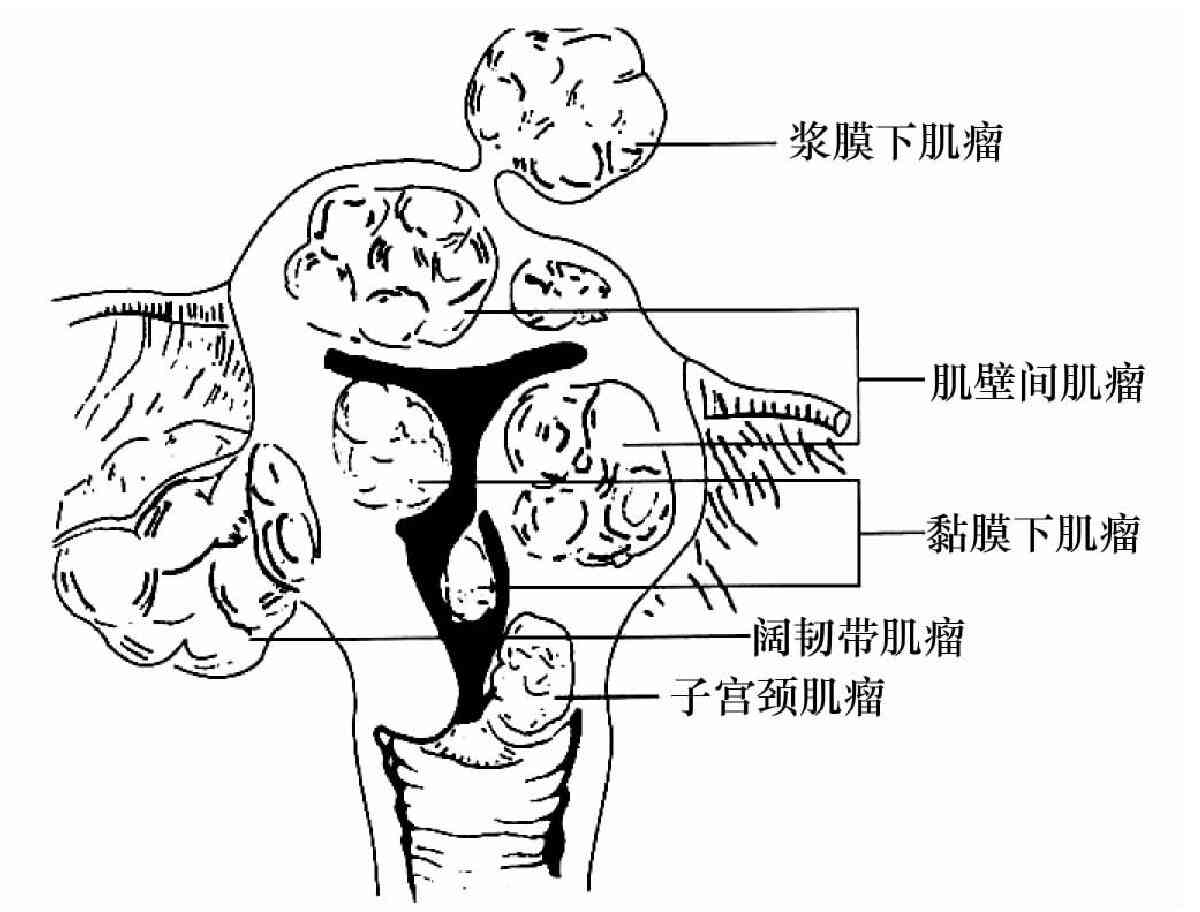 揭开子宫<span style="color: #da4707">肌瘤</span>的神秘面纱