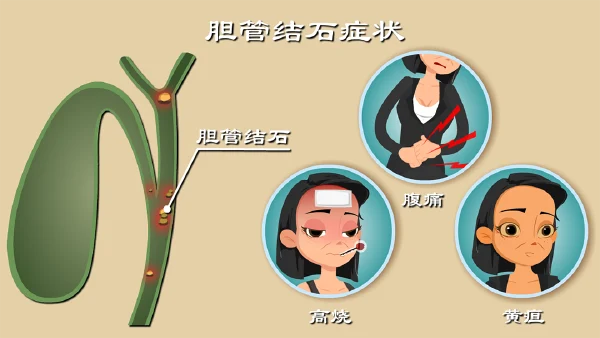 12年肝内胆管结石竟能如此严重！你需要了解这些