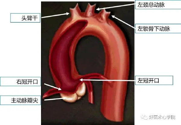 全面解析升主动脉瘤及其相关心血管疾病:病因、诊断与治疗