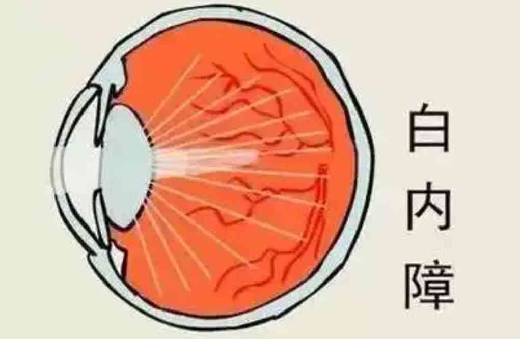 70岁老人大闹<span style="color: #da4707">眼科</span>？白内障竟然这么可怕！