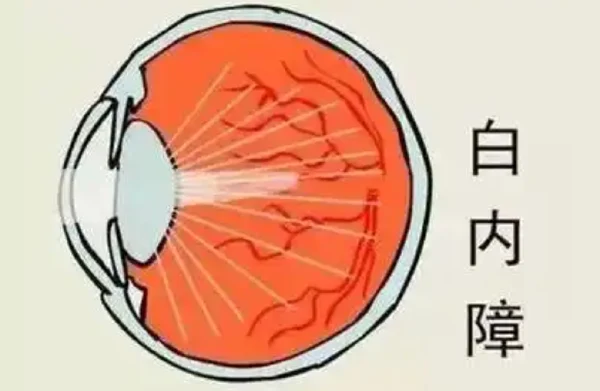 70岁老人大闹眼科？白内障竟然这么可怕！